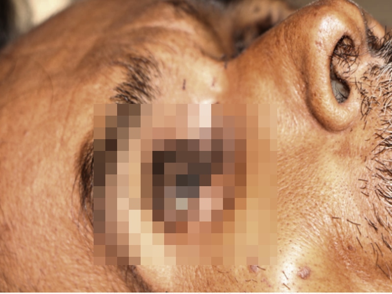 आँख में चींटियां