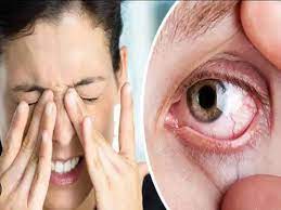 आई फ्लू का संक्रमण तेजी से फ़ैल रहा