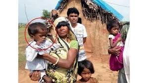 श्योपुर में मिले 240 कुपोषित बच्चे