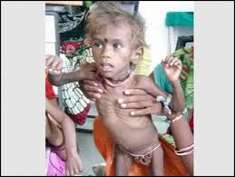 श्योपुर में मिले 240 कुपोषित बच्चे